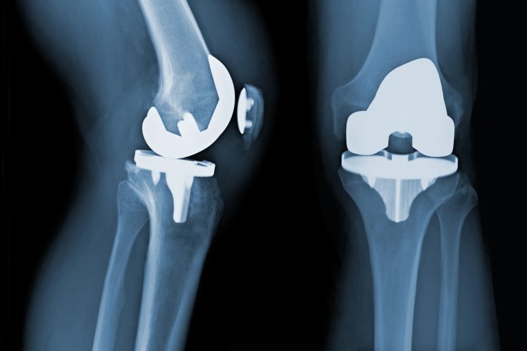 Ceramic knee implant seen in leg xray.