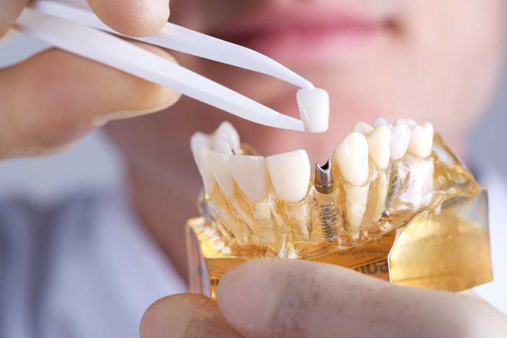 Dentist holding a dental implant model, adhering to ANSI/ADA 173-2019.