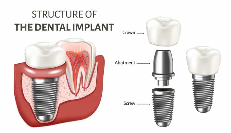 Structure of a dental implant that contains a screw, abutment, crown.